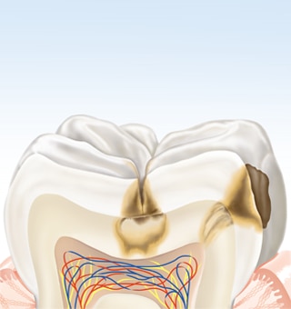 about-karies-tooth3-de.png