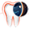Počiatočný zubný kaz